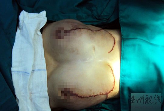 海南16岁"巨乳症"