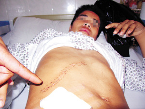 两名少年抓贼被刺一人身中8刀 窃贼自称遭追杀