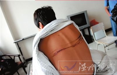 一名伤者背部至今还有明显的伤疤。