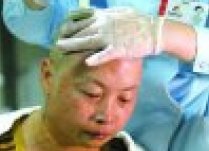 母亲割皮救子 39岁的母亲唐淑金救儿整个头皮植到