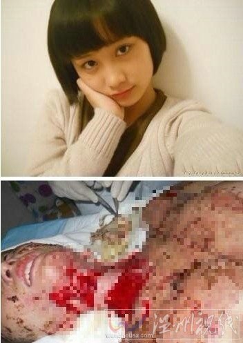 周岩被烧伤前后对比(图片来自家属李聪微博)