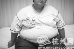 切胃减肥又称缩胃手术减肥 体重180公斤大一学生太胖