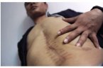 男子左肾失踪 湖南25岁男子接受脾脏切除手术左肾不