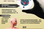 h7n9诊疗方案 卫计委公布h7n9禽流感诊断流程和治疗方