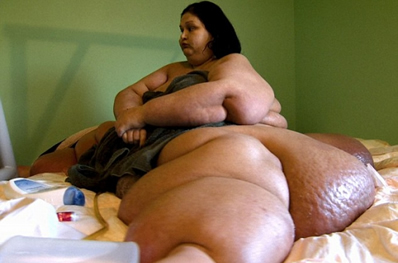 美国最胖女子梅拉体重544公斤 减肥后体重181公斤