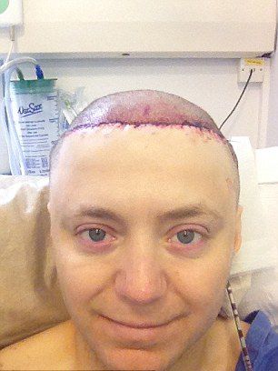 英国男子头皮植入气球来生发