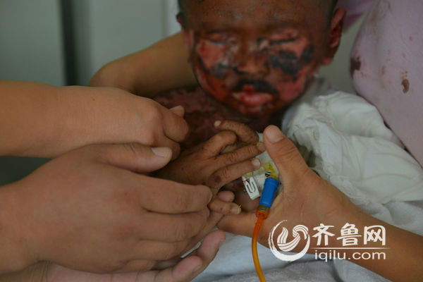 中毒性表皮坏死松解症男童