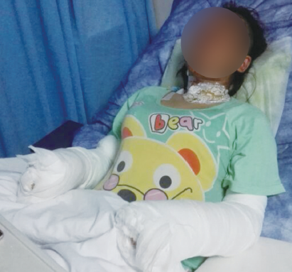 手持氢气球爆炸烧成造成20%烧伤,温州女子被氢气球炸伤