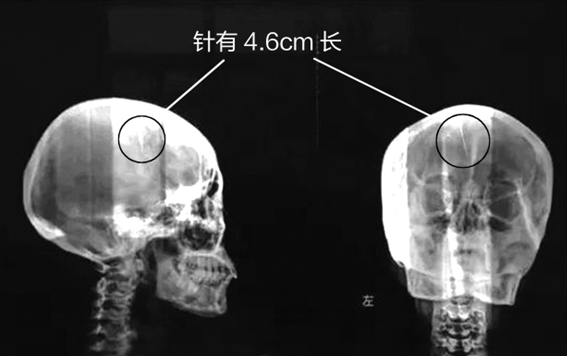 脑里藏针46年